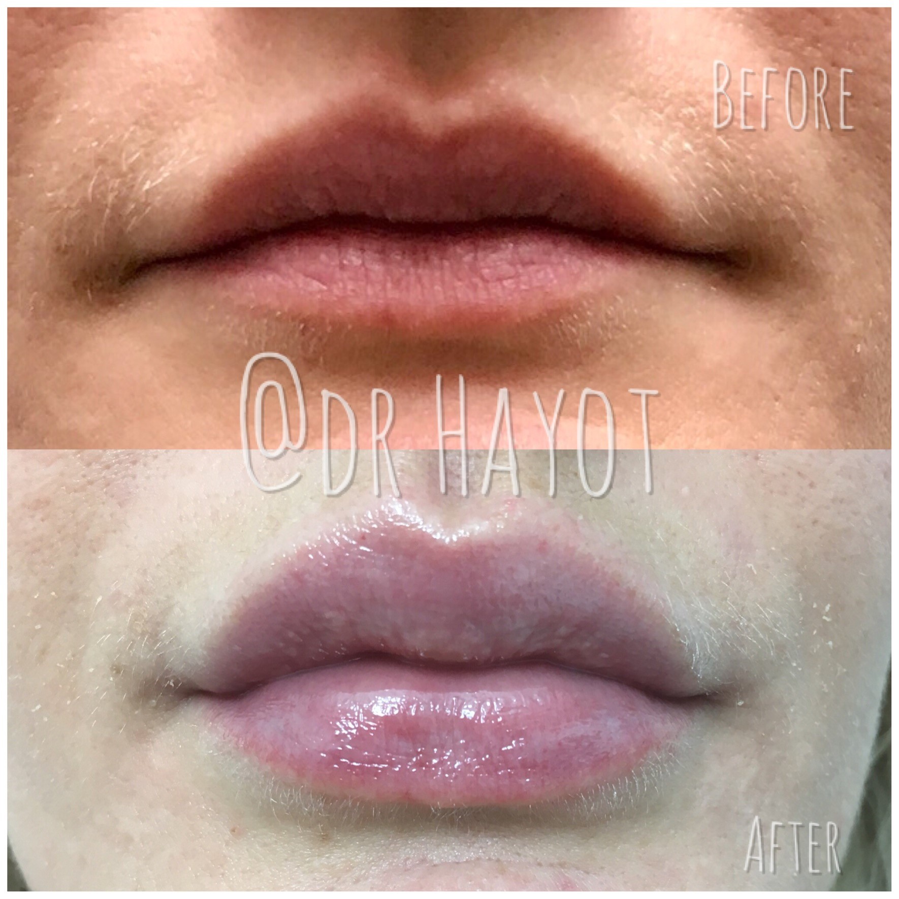 Dermal Filler for lips results