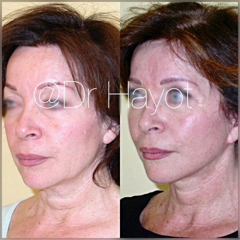 Before and after eye lift treatment