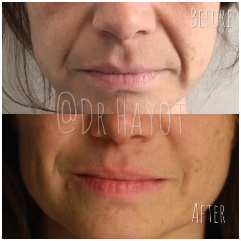 Results of anti-wrinkle injections on the face around the mouth