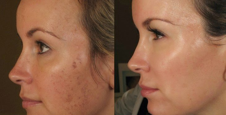 Dermapen before and after image of woman's face with acne and scarring