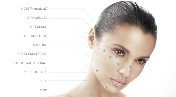 Locations on the face which are ideal for Dermal Fillers