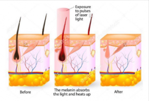 Diagram of hair follicle undergoing laser hair removal treatment for pubic area